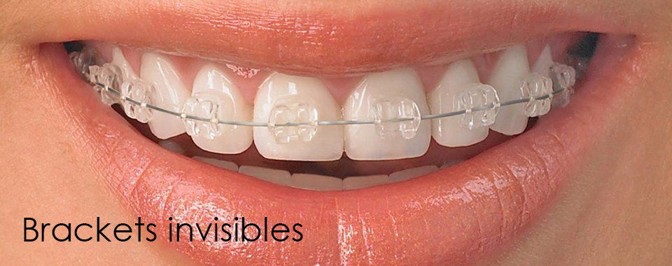 Ortodoncia metálica invisible