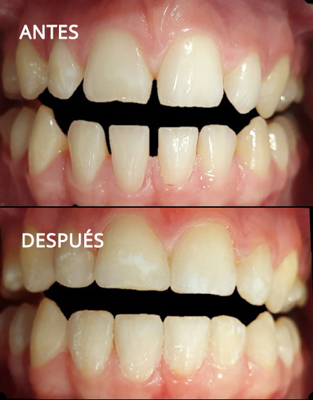 Carillas dentales para dientes desgastados