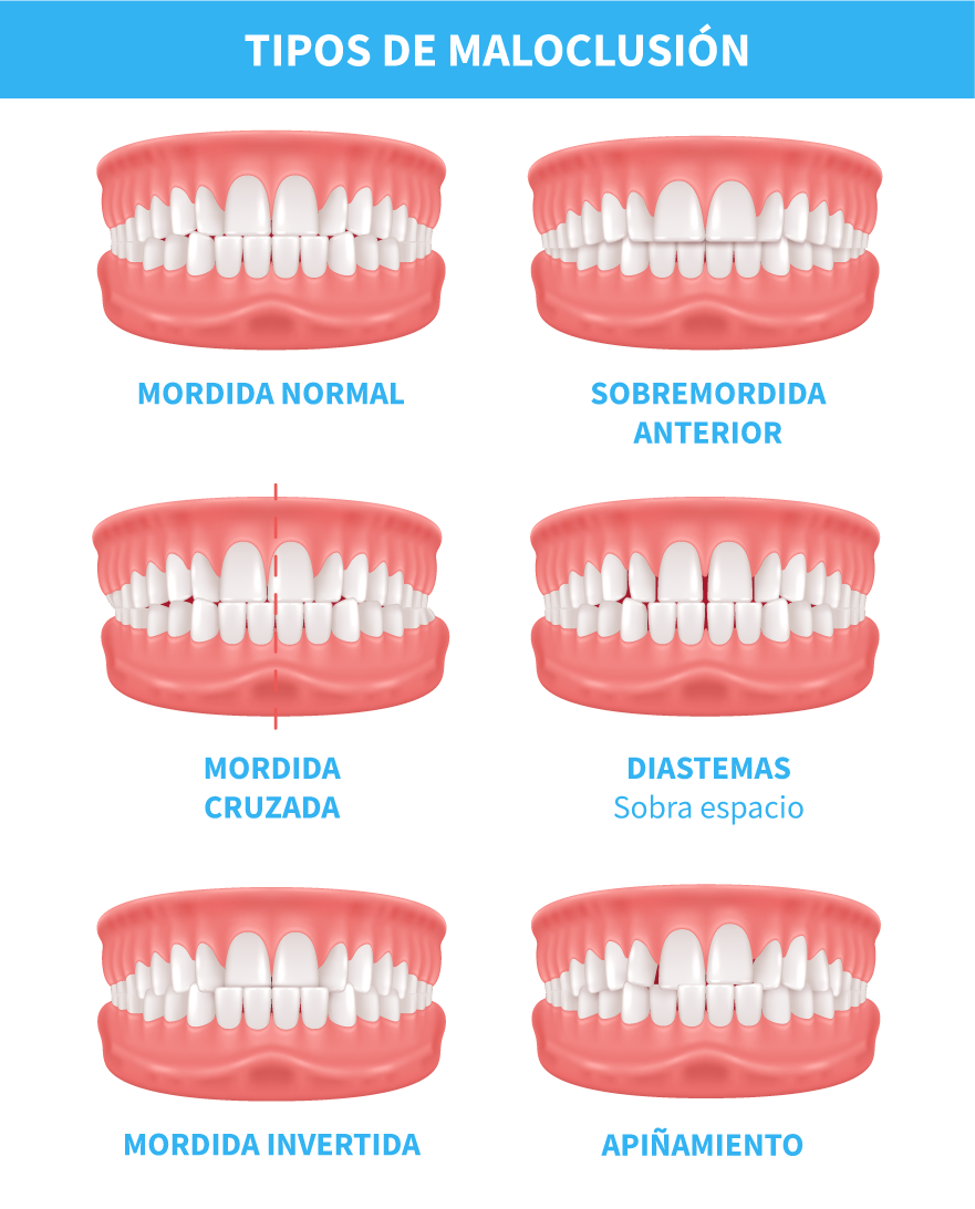 Cuándo ponerse brackets y lucir una sonrisa perfecta – Clínica Dental ...